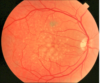 An eye with Dry AMD showing drusen in the macula