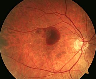 An eye with new-onset Wet AMD (right) showing drusen with a subretinal hemorrhage.