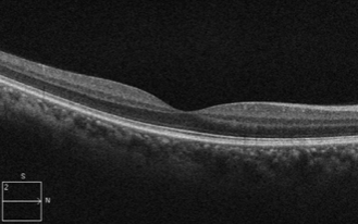 OCT of an eye with an epiretinal membrane