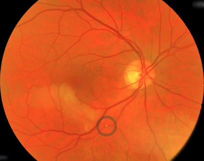 Clinical appearance of a visible plaque in a retinal artery causing a BRAO.  The area of the retina affected by the BRAO has turned white.