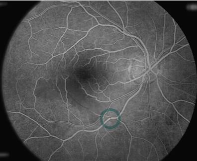  Fluorescein Angiogram of above eye showing poor bloodflow downstream from blockage.