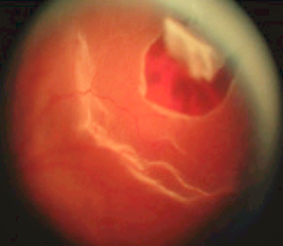 A retinal tear associated with a retinal detachment.