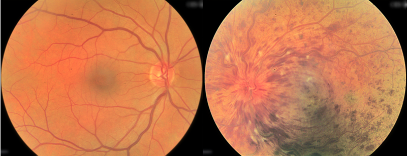 Fundus photo of a normal eye (left) compared with a CRVO in the fellow eye (right)